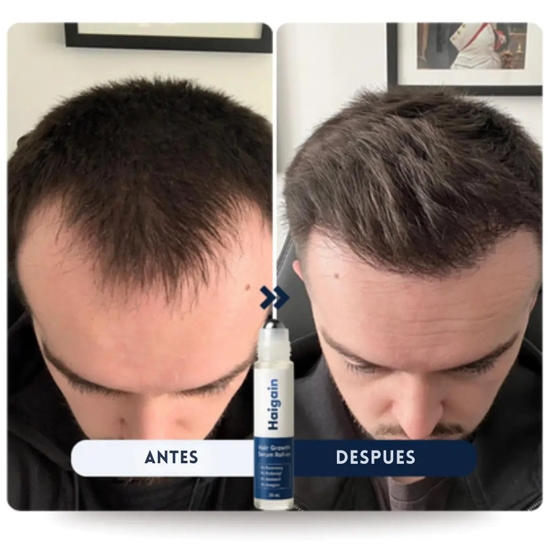 Recupera tu línea del cabello  y forja un cabello  más abundante, grueso y fuerte ¡En sólo 2 semanas!